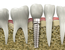 Implant